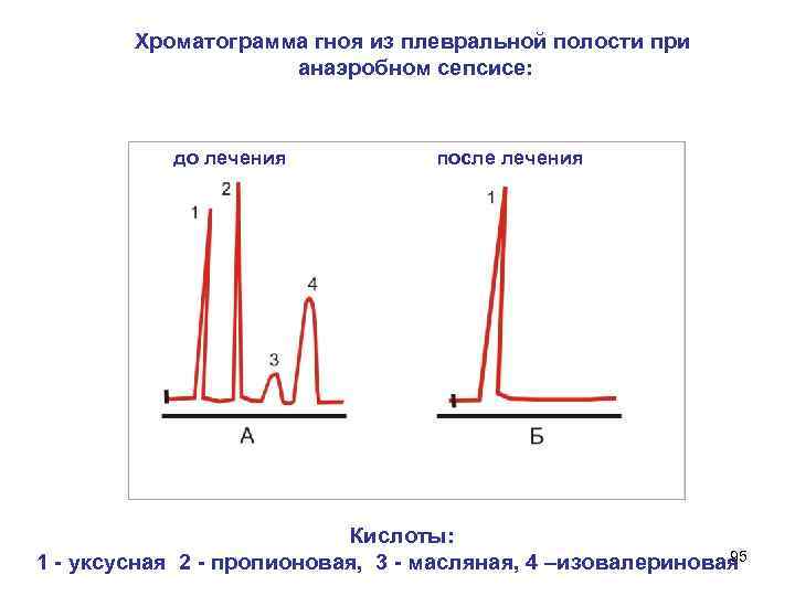  Хроматограмма гноя из плевральной полости при анаэробном сепсисе: до лечения после лечения Кислоты: