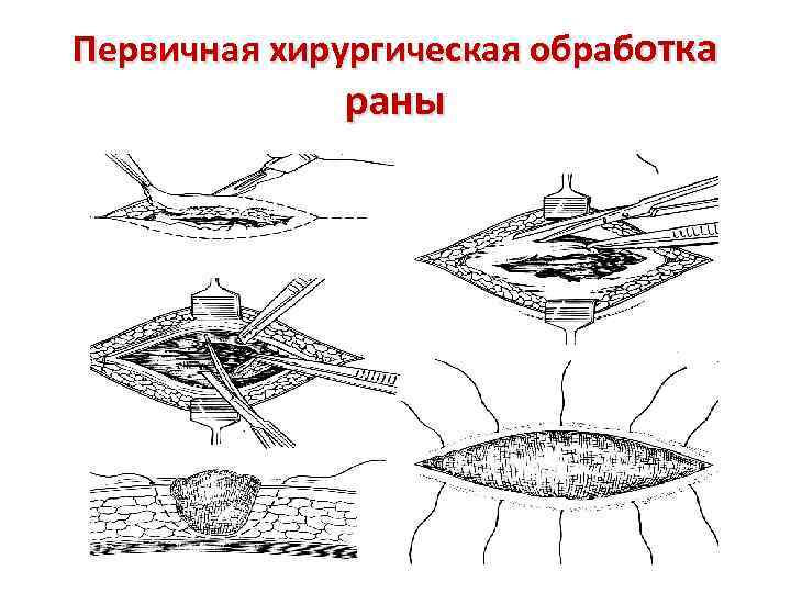 Первичная хирургическая обработка раны 
