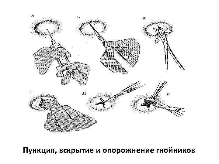 Пункция, вскрытие и опорожнение гнойников 