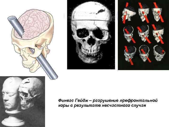 Финеас Гейдж – разрушение префронтальной коры в результате несчастного случая 