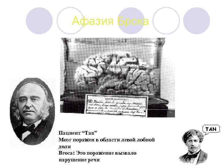 Афазия Брока Пациент “Tan” Мозг поражен в области левой лобной доли Broca: Это поражение