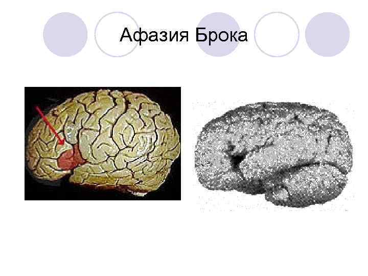 Афазия Брока 
