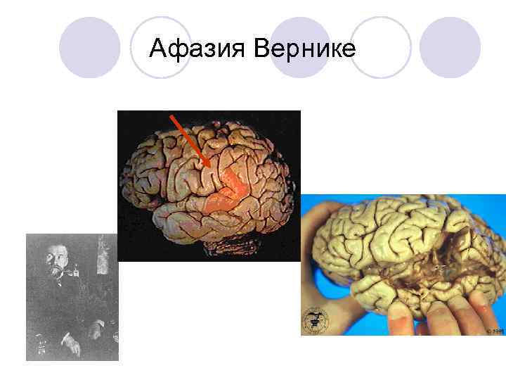 Афазия Вернике 