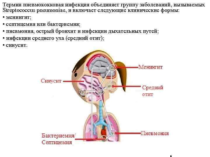 Термин пневмококковая инфекция объединяет группу заболеваний, вызываемых Streptococcus pneumoniae, и включает следующие клинические формы: