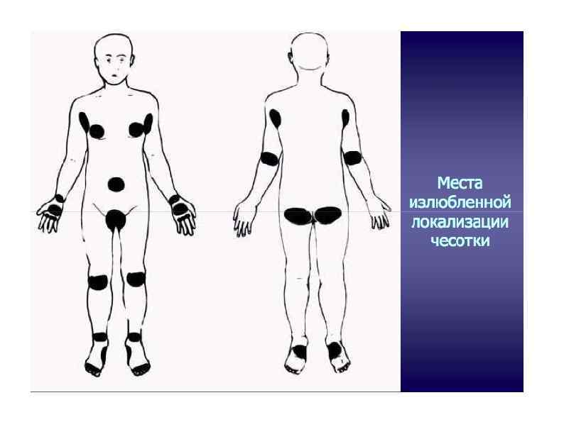 Отметь на теле. Чесотка места локализации. Чесотка места локализации у взрослых. Места типичной локализации чесотки. Места излюбленной локализации чесотки.