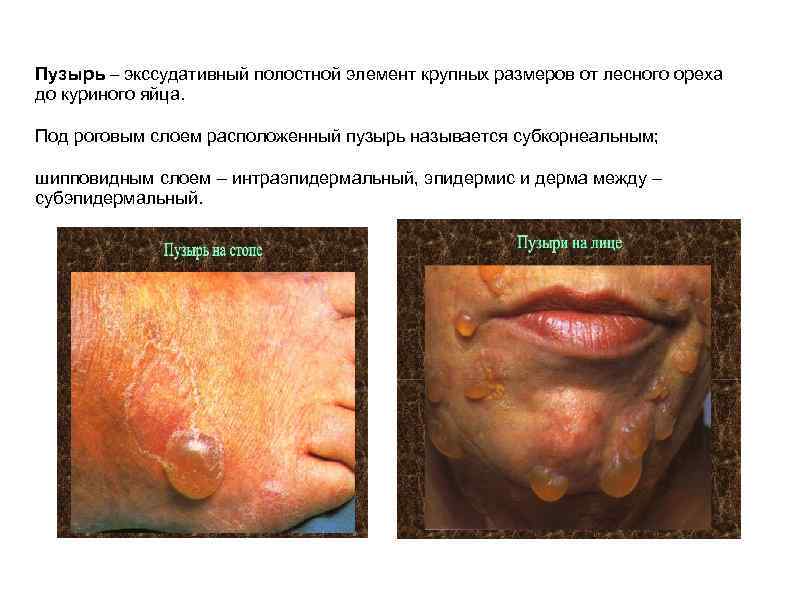 Пузырь – экссудативный полостной элемент крупных размеров от лесного ореха до куриного яйца. Под