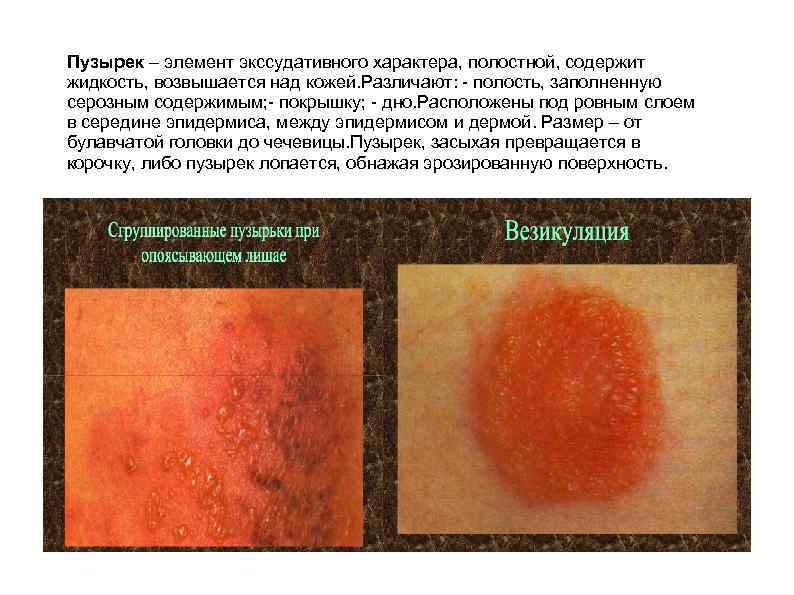 Пузырек – элемент экссудативного характера, полостной, содержит жидкость, возвышается над кожей. Различают: - полость,