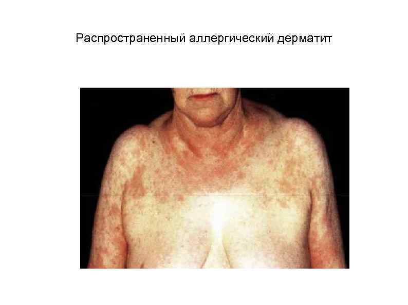 Распространенный аллергический дерматит 