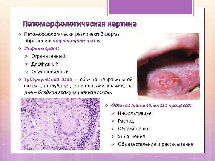 Патоморфологическая картина v v v Патоморфологически различают 2 формы поражения: инфильтрат и язву Инфильтрат: