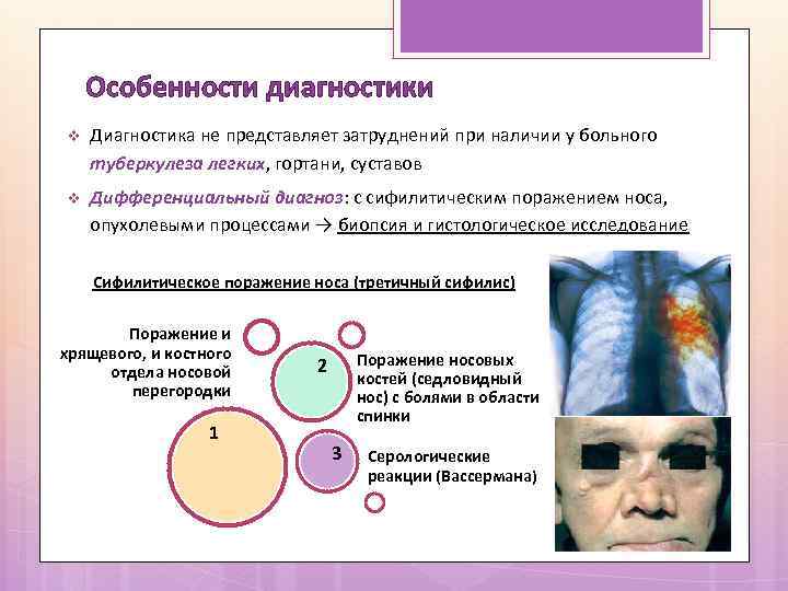 Особенности диагностики v Диагностика не представляет затруднений при наличии у больного туберкулеза легких, гортани,