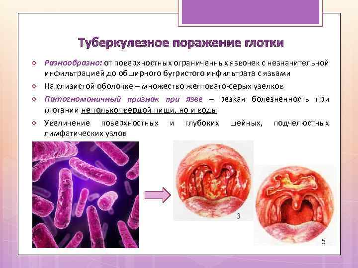 Туберкулезное поражение глотки v v Разнообразно: от поверхностных ограниченных язвочек с незначительной инфильтрацией до