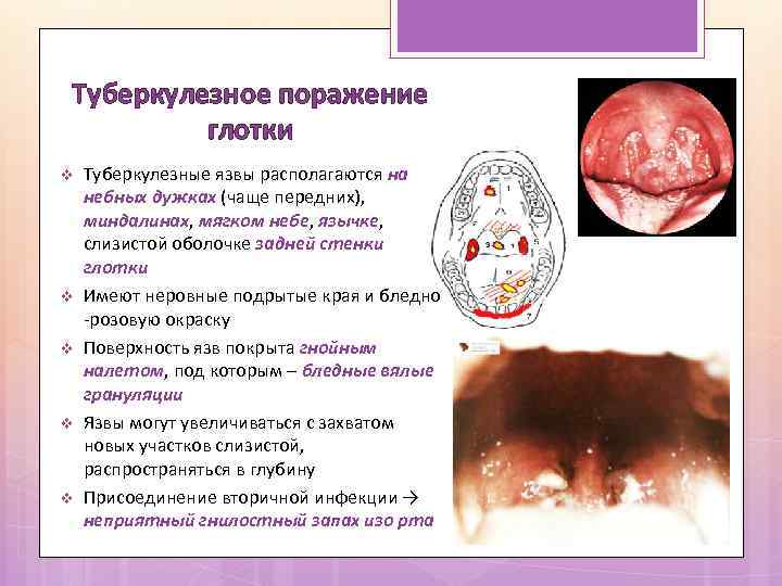 Туберкулезное поражение глотки v v v Туберкулезные язвы располагаются на небных дужках (чаще передних),