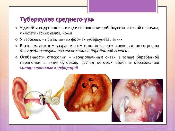 Туберкулез среднего уха v v У детей и подростков – в виде осложнения туберкулеза