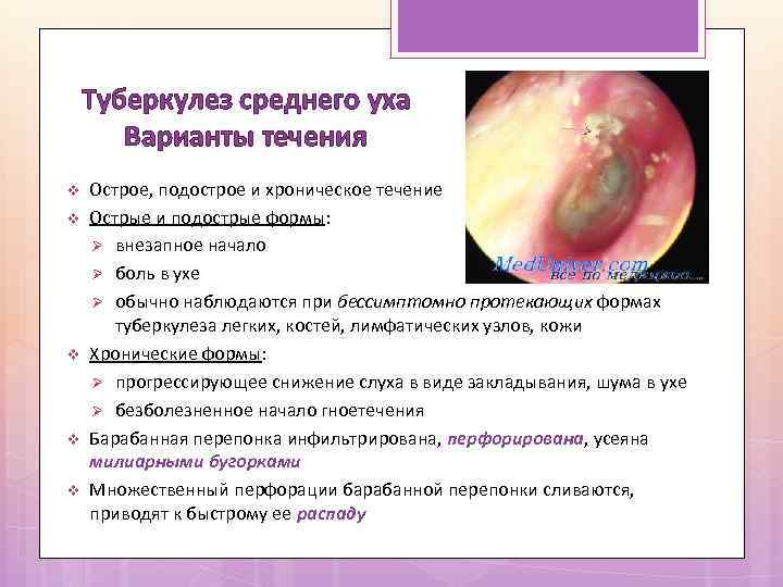 Туберкулез среднего уха Варианты течения v v v Острое, подострое и хроническое течение Острые