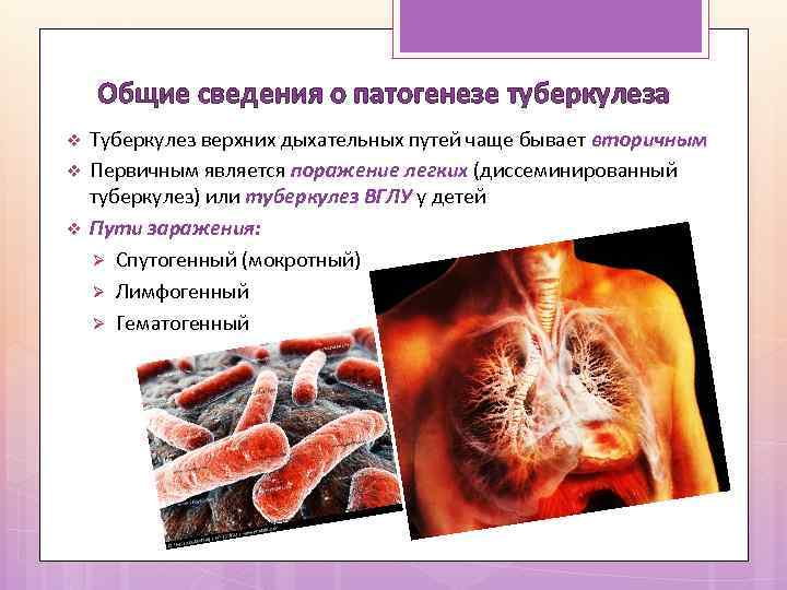 Общие сведения о патогенезе туберкулеза v v v Туберкулез верхних дыхательных путей чаще бывает