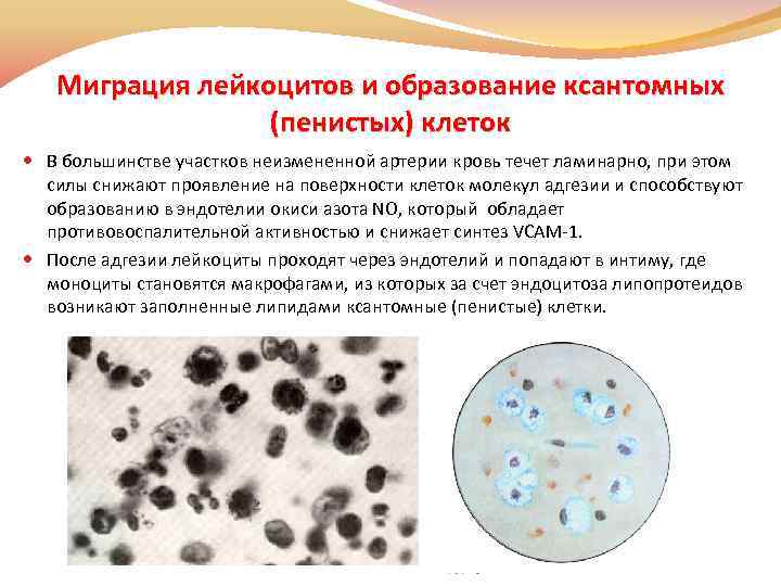Миграция лейкоцитов и образование ксантомных (пенистых) клеток В большинстве участков неизмененной артерии кровь течет