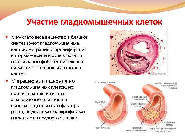 Участие гладкомышечных клеток Межклеточное вещество в бляшке синтезируют гладкомышечные клетки, миграция и пролиферация которых