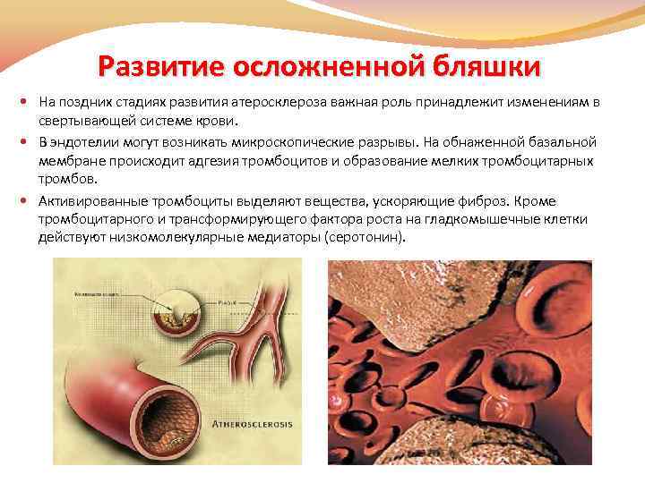 Развитие осложненной бляшки На поздних стадиях развития атеросклероза важная роль принадлежит изменениям в свертывающей