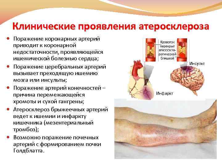 Клинические проявления атеросклероза Поражение коронарных артерий приводит к коронарной недостаточности, проявляющейся ишемической болезнью сердца;