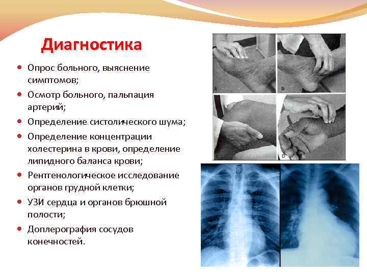 Диагностика Опрос больного, выяснение симптомов; Осмотр больного, пальпация артерий; Определение систолического шума; Определение концентрации
