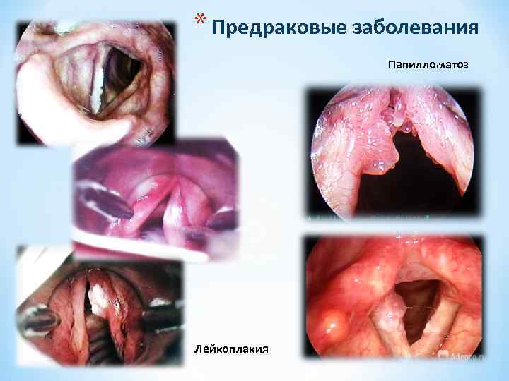 * Предраковые заболевания Папилломатоз Лейкоплакия 
