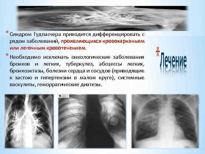 * Синдром Гудпасчера приходится дифференцировать с рядом заболеваний, проявляющихся кровохарканьем или легочным кровотечением *