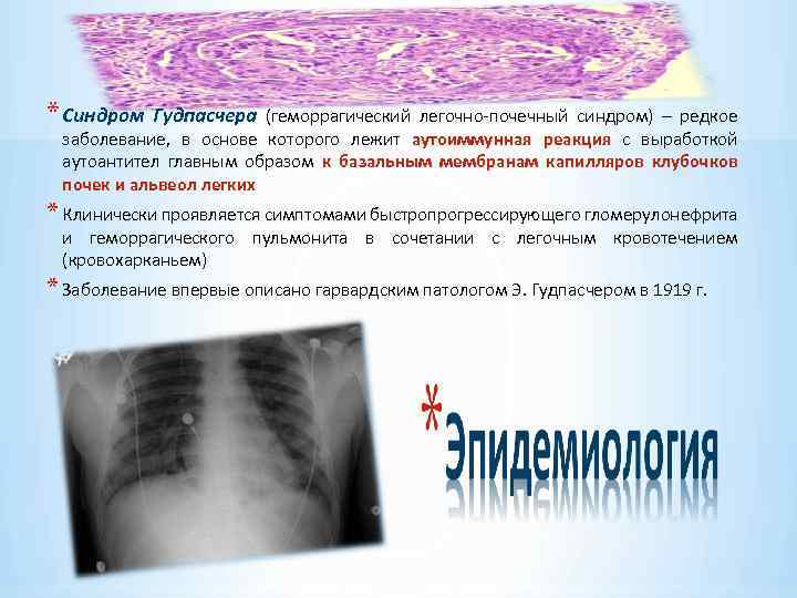 * Синдром Гудпасчера (геморрагический легочно-почечный синдром) – редкое заболевание, в основе которого лежит аутоиммунная