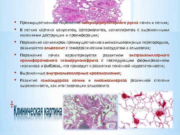  • • Преимущественное поражение микроциркуляторного русла почек и легких; • Поражение капилляров преимущественно