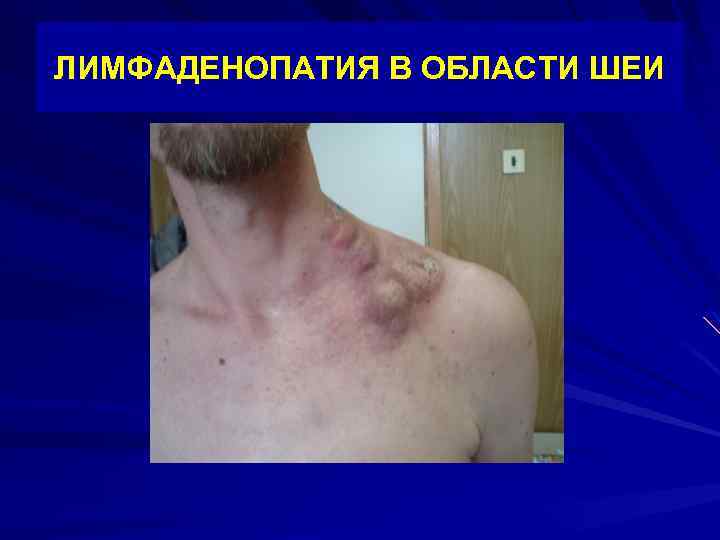 ЛИМФАДЕНОПАТИЯ В ОБЛАСТИ ШЕИ 