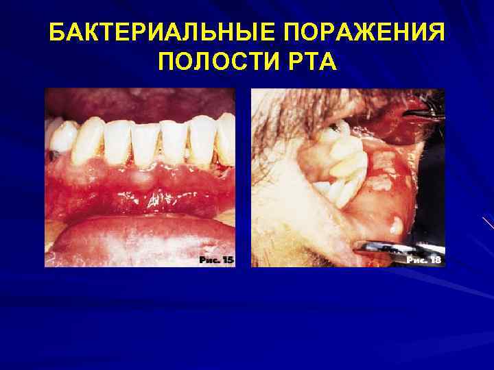 БАКТЕРИАЛЬНЫЕ ПОРАЖЕНИЯ ПОЛОСТИ РТА 