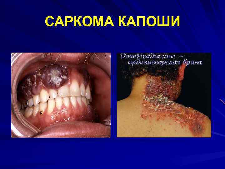 САРКОМА КАПОШИ 