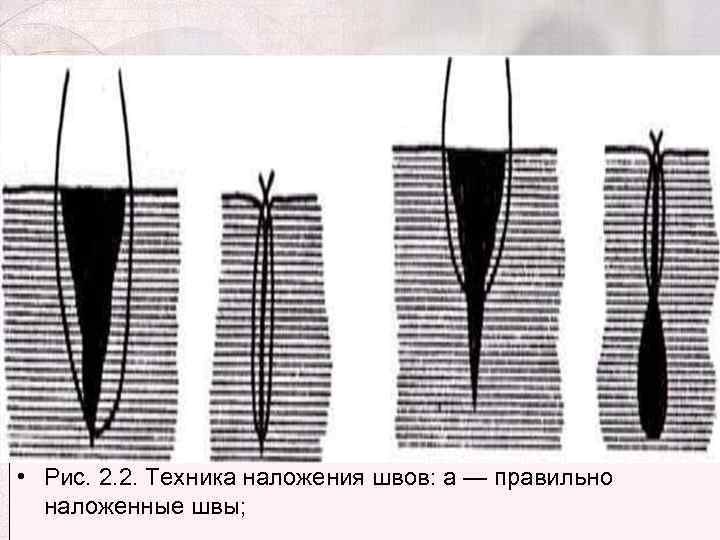  • Рис. 2. 2. Техника наложения швов: а — правильно наложенные швы; 