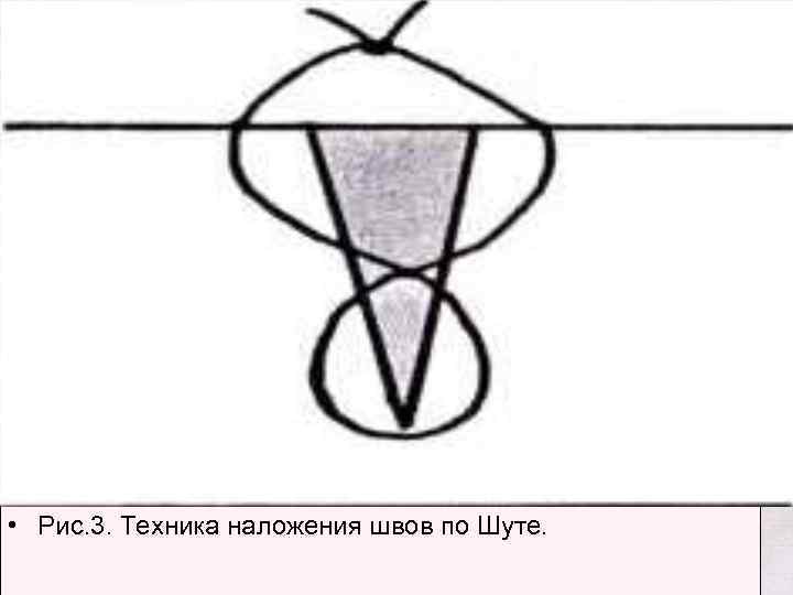  • Рис. 3. Техника наложения швов по Шуте. 