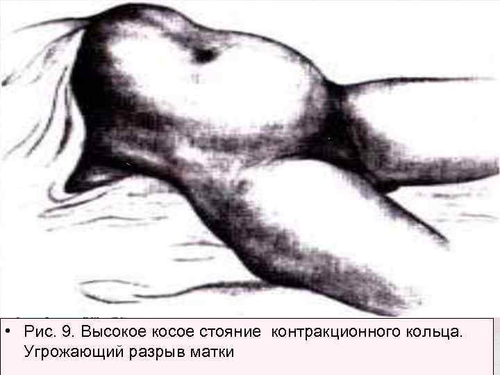  • Рис. 9. Высокое косое стояние контракционного кольца. Угрожающий разрыв матки 