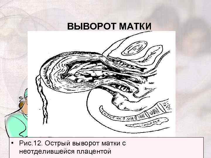 Выворот матки презентация