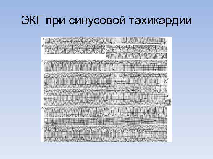 ЭКГ при синусовой тахикардии 