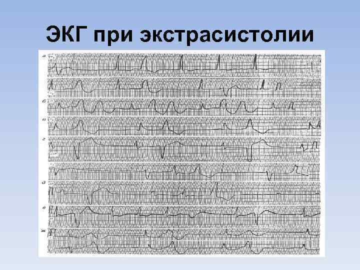 ЭКГ при экстрасистолии 