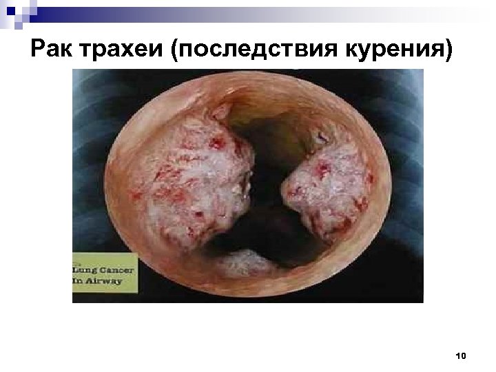 Рак трахеи (последствия курения) 10 