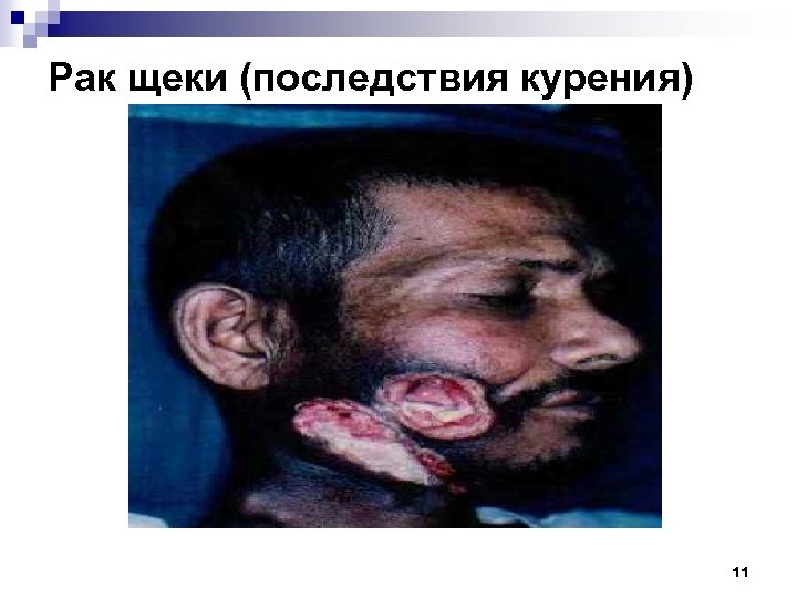 Рак щеки (последствия курения) 11 