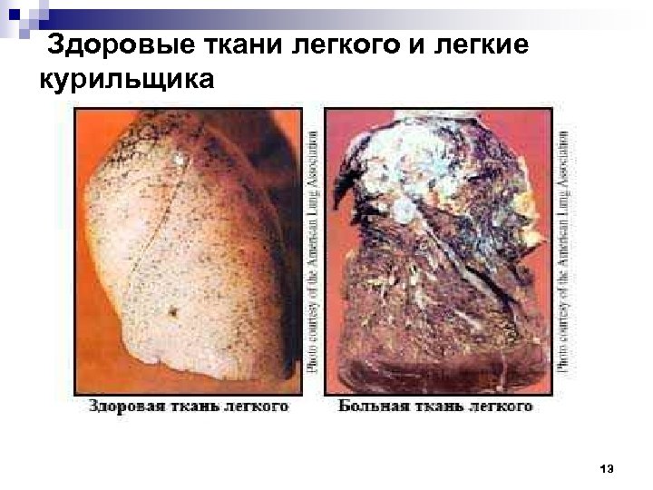 Здоровые ткани легкого и легкие курильщика 13 