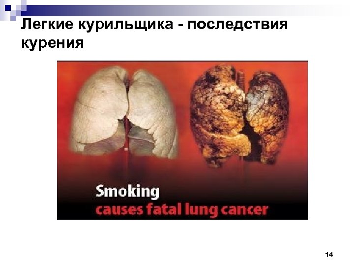 Легкие курильщика - последствия курения 14 