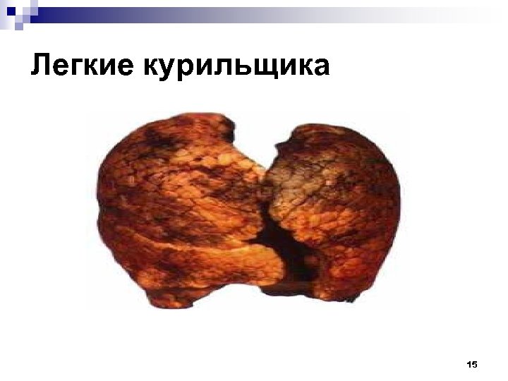 Легкие курильщика 15 