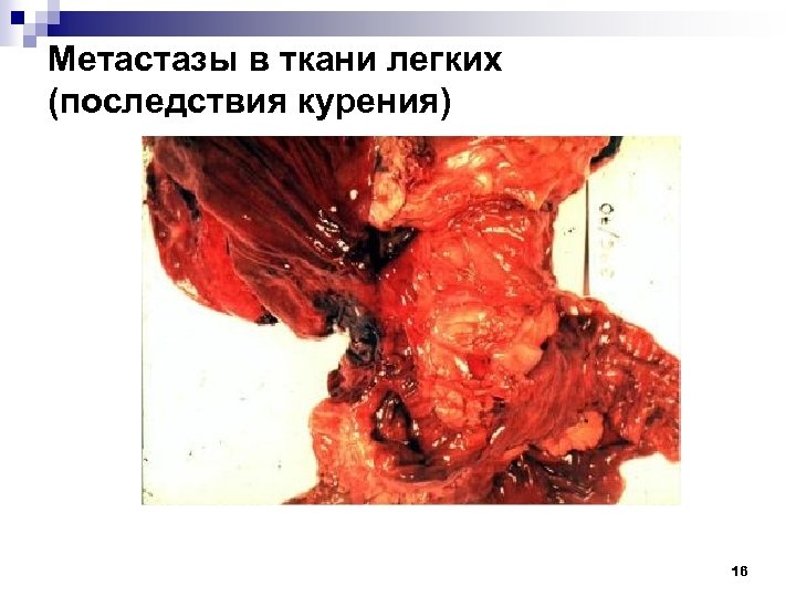 Метастазы в ткани легких (последствия курения) 16 