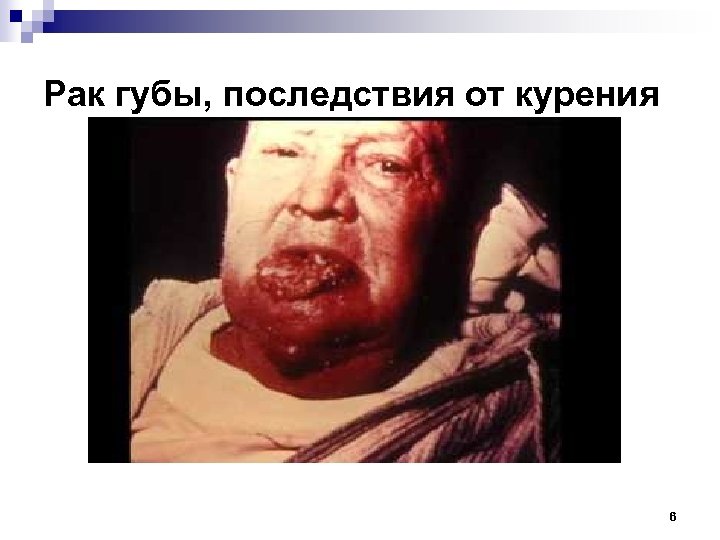 Рак губы, последствия от курения 6 