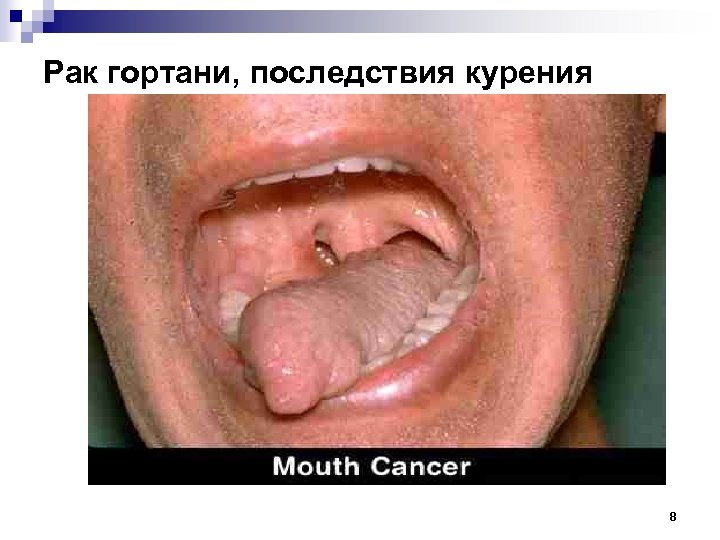 Рак гортани, последствия курения 8 