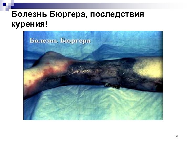 Болезнь Бюргера, последствия курения! 9 