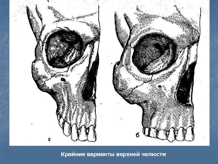 Крайние варианты верхней челюсти 