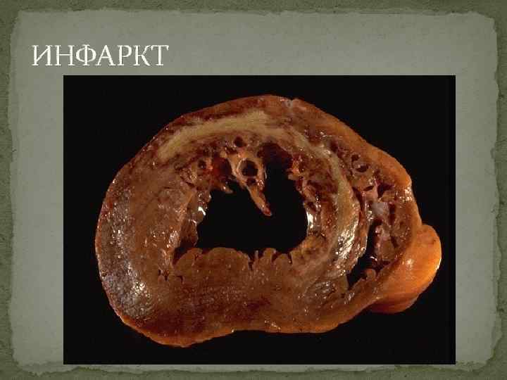 ИНФАРКТ 