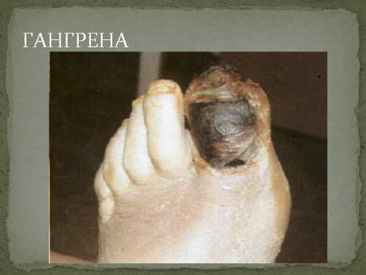 ГАНГРЕНА 