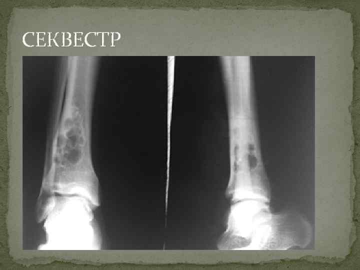 Некроз кости. Остеомиелит рентген секвестр. Костный секвестр остеомиелит рентген. Секвестрация кости рентген.